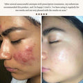Primalderm High Frequency Therapy