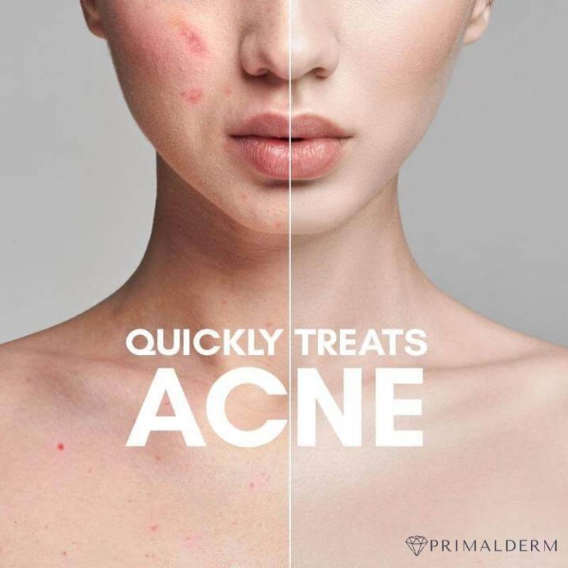 Primalderm High Frequency Therapy | Clear Acne and Prevent Future Breakouts