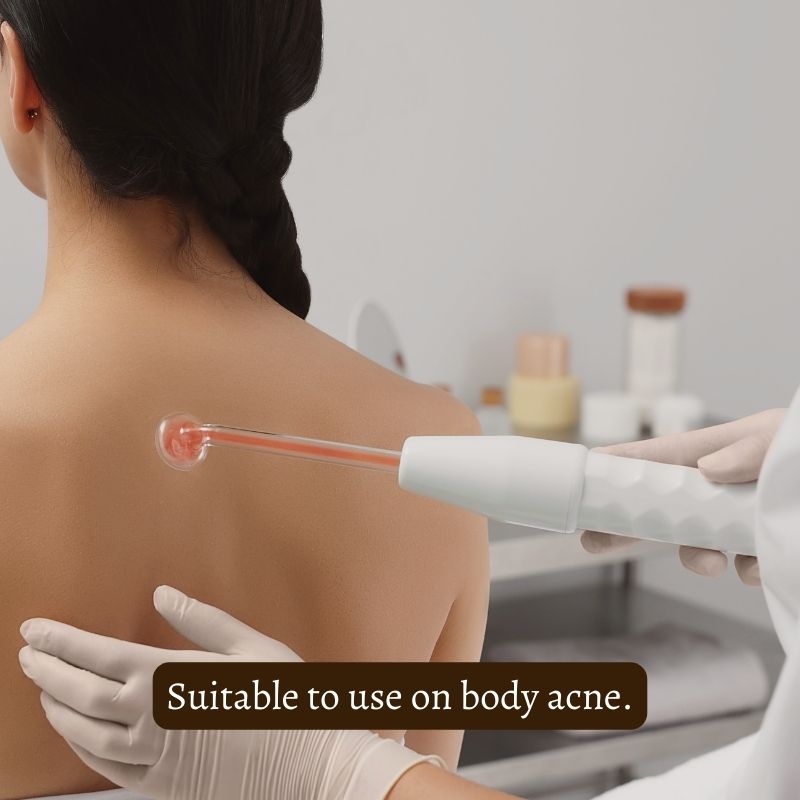 Primalderm High Frequency Therapy | Clear Acne and Prevent Future Breakouts